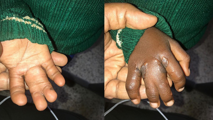 A child born with four fingers webbed together. This picture was taken after the first surgery to release two fingers (the little finger and finger next to thumb) had been done, by a plastic surgeon at Rwanda Military Hospital./ Courtesy photo