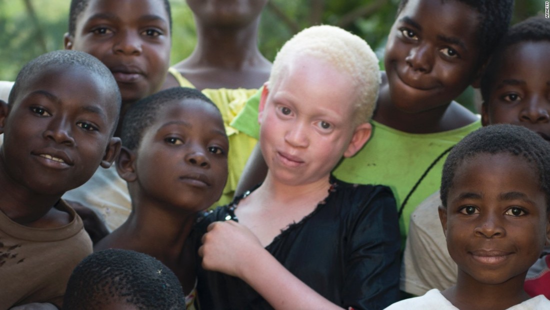 In some parts of Africa, albino bones are used by witch doctors, who believe the body parts bring wealth, happiness. / Internet photo