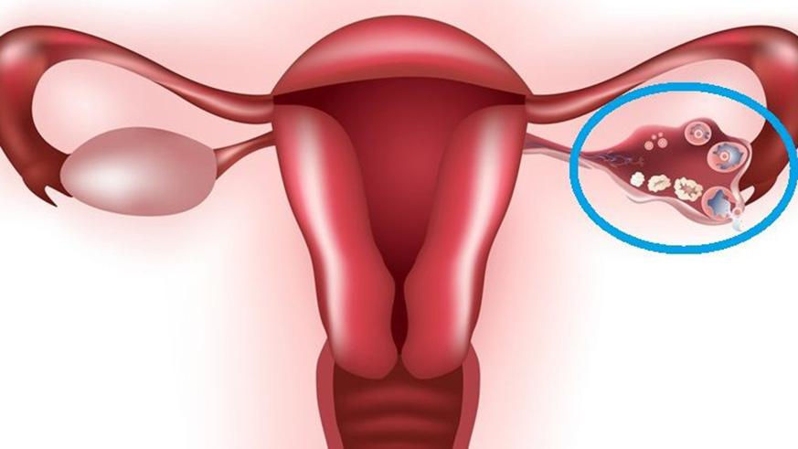 There is no way to prevent ovarian cyst growth, however; regular pelvic examination will allow for early treatment relieve the pain. / Net photo