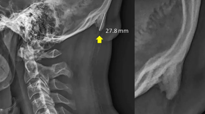 Researchers at the University of the Sunshine Coast in Queensland, Australia, have documented the prevalence of bone spurs at the back of the skull among young adults. / Internet photo