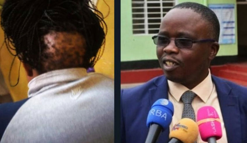 A photo of Olive Kamaliza showing the back of her head where she says her hair was uprooted by her husband Augustin Ndabereye (right). 