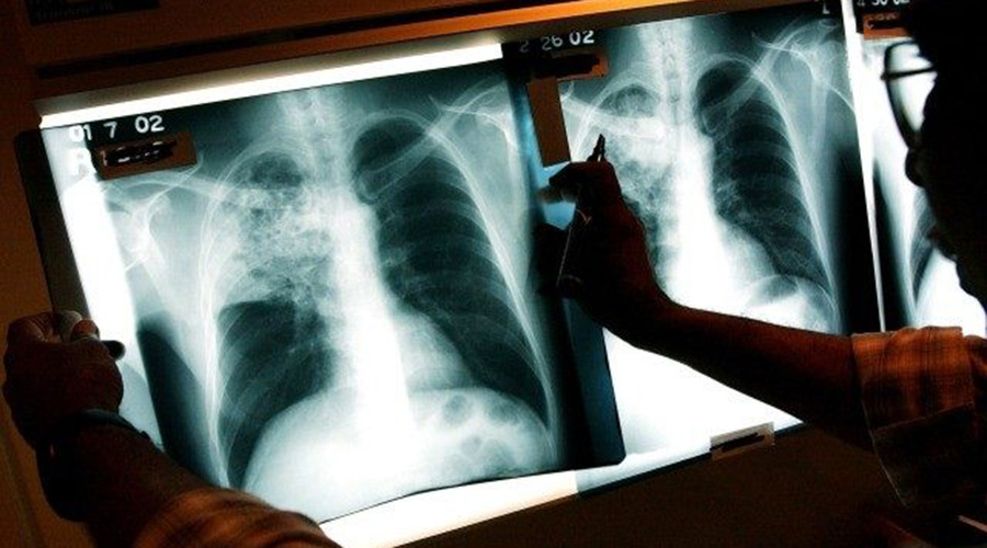 A health worker checks x-rays for respiratory diseases. Rwanda intends to increase public awareness on TB diagnosis, treatment, and prevention among Rwandan community. 