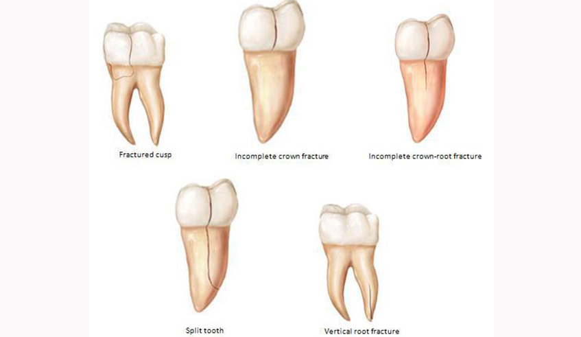 The cracks in the teeth can be in any part of the tooth. Net illustration