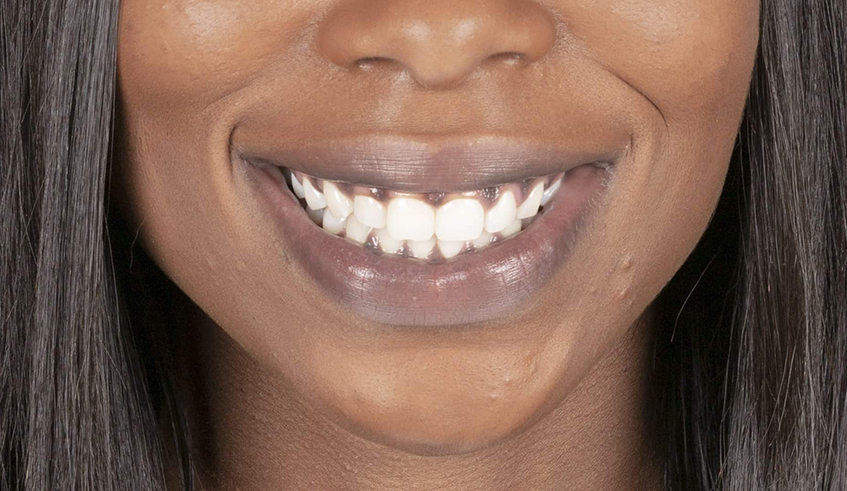 A gum infection is an oral infection that causes damage and inflammation in the gums and jaw. Experts advise to examine gums and note any signs of inflammation. / Photo: Net