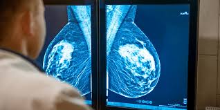 Breast density is a term that describes the relative amount of these different types of breast tissue as seen on a mammogram. Photo/Net