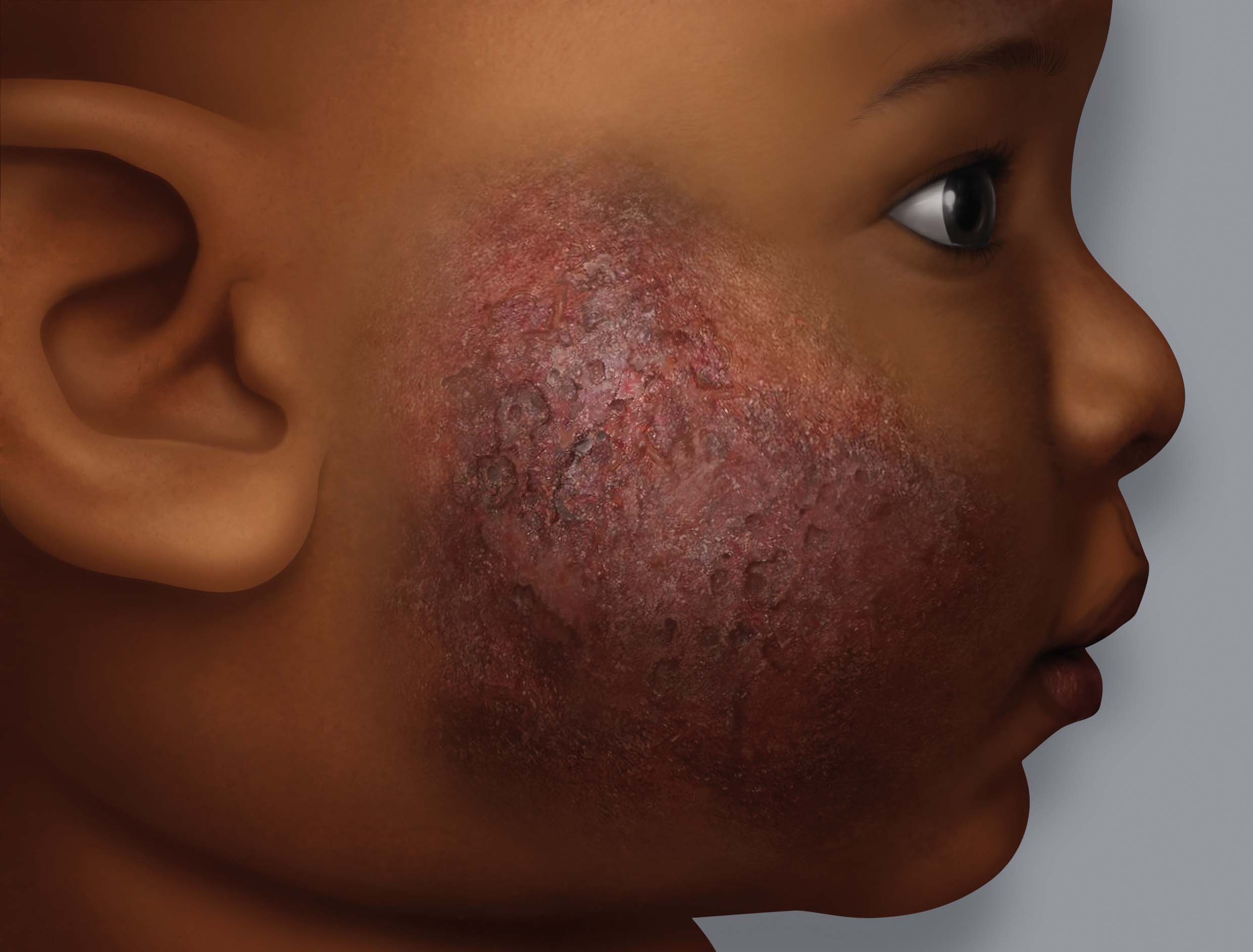 This skin condition is very common in children, but adults can get it too. Photo/Net